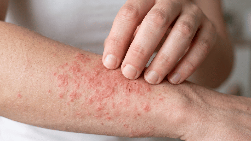 Tantangan Kulit Sensitif Terhadap Produk Antiseptik